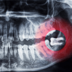 cirugia bucal maxilofacial interlomas cdmx mexico marion ormeno