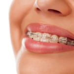 ortodoncia-interlomas-cdmx-mexico-marion-ormeno-3