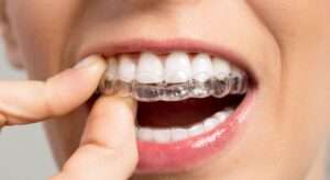 Ortodoncia invisible invisalign